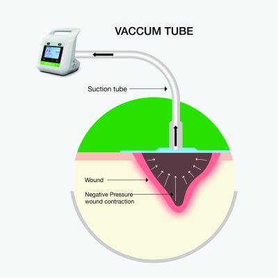 following mechanisms